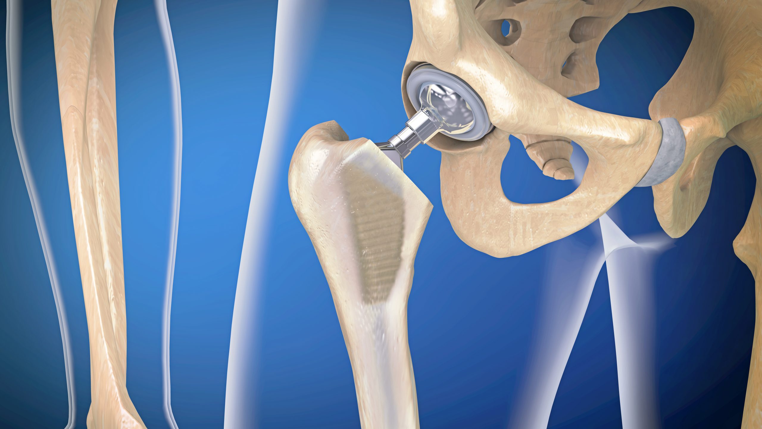 Was tun bei Hftgelenksprothese? - PHYSIOZENTRUM